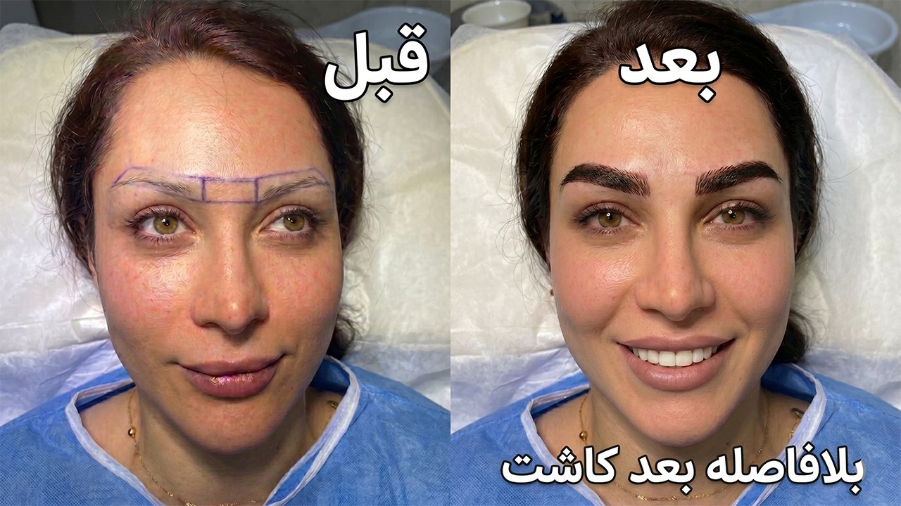 کاشت ابرو با موهای بلند👇فیلم کاشت رو ببین🥰